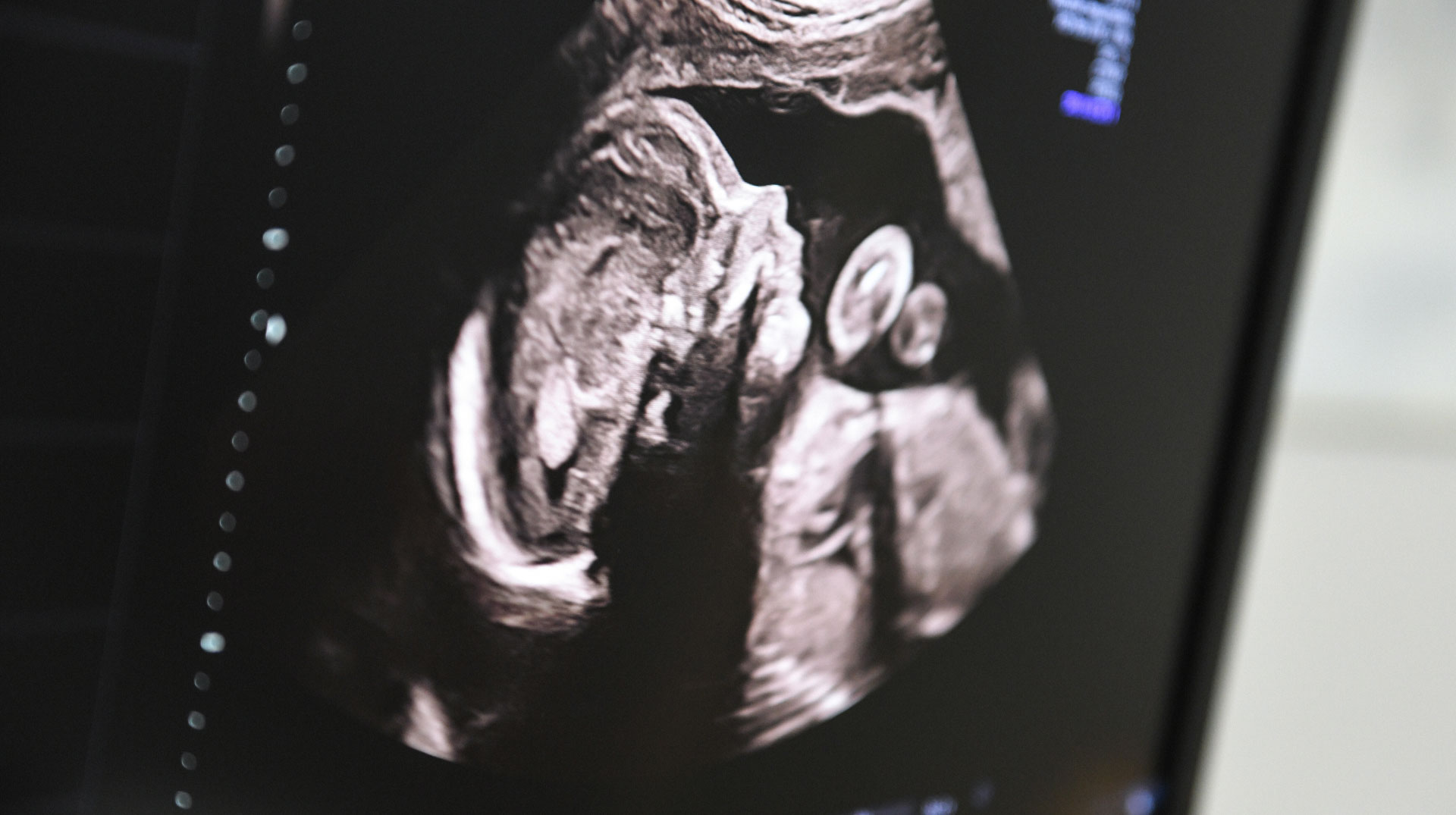 Ultraschallbild eines Ungeborenen auf einem Monitor während einer Ultraschalluntersuchung am 18. September 2019 in Bonn.